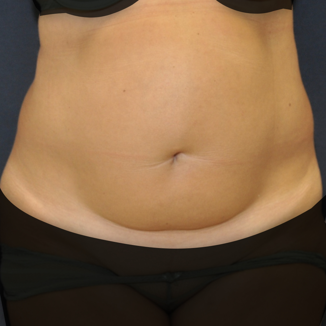 abdominoplastia-01-01 Abdominoplastia