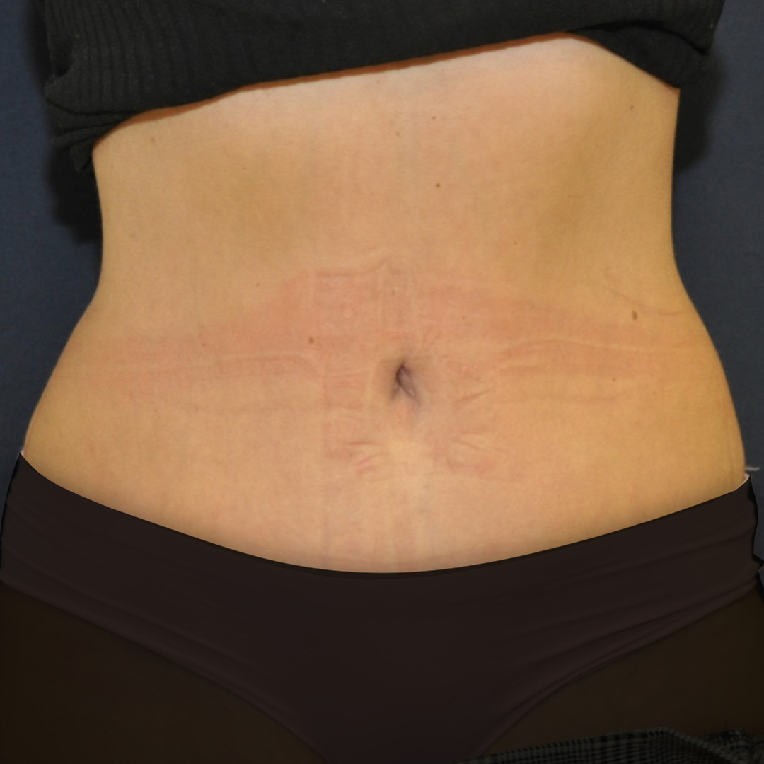 abdominoplastia-01-02 Abdominoplastia