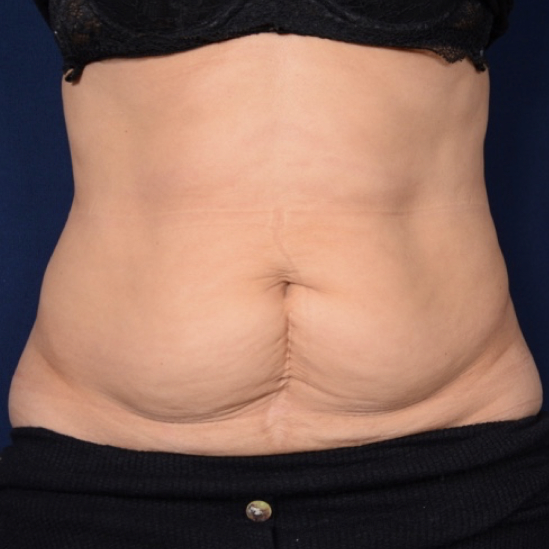 abdominoplastia-02-01 Abdominoplastia