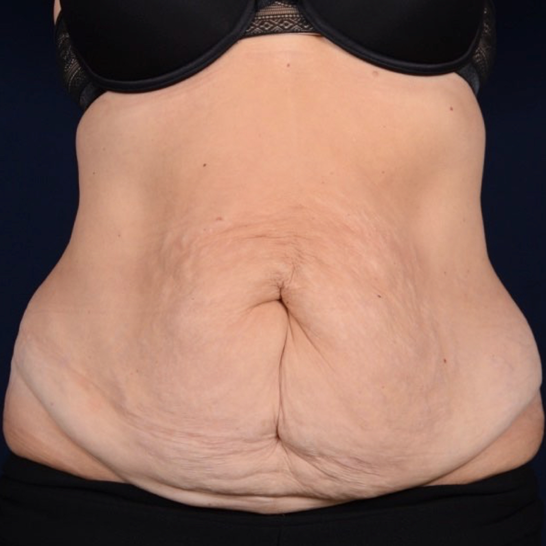 abdominoplastia-03-01 Abdominoplastia