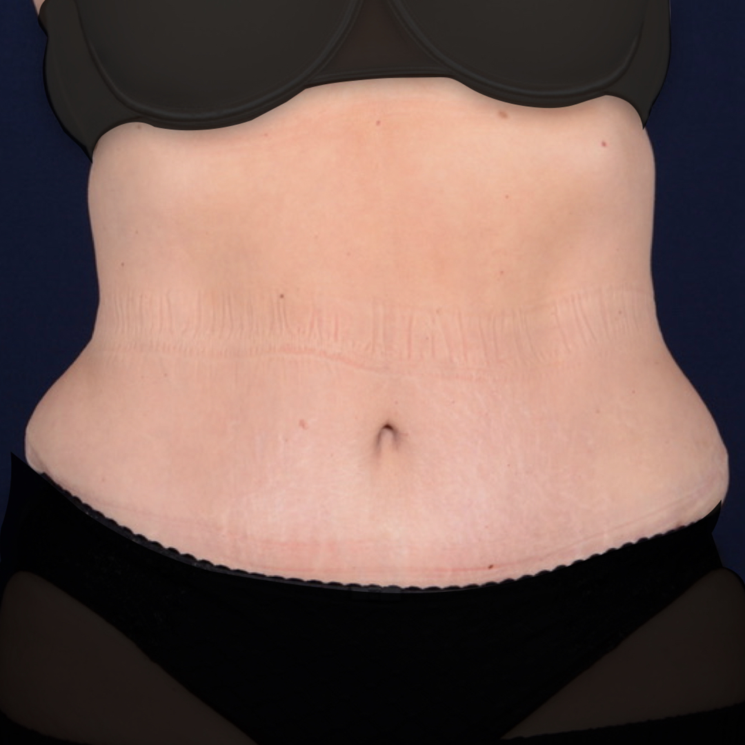 abdominoplastia-03-02 Abdominoplastia