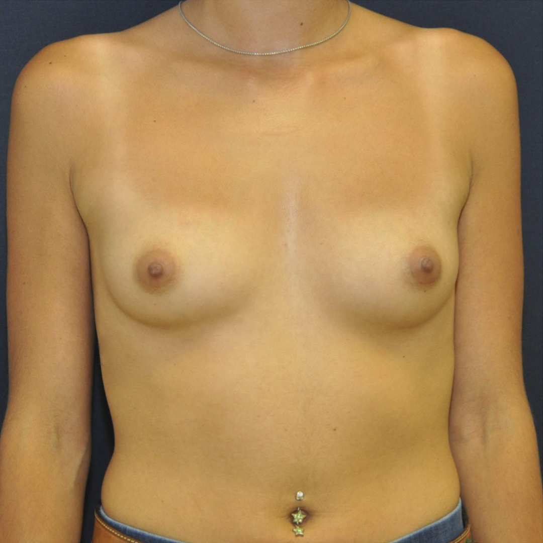 aumento-01-01 Breast Augmentation