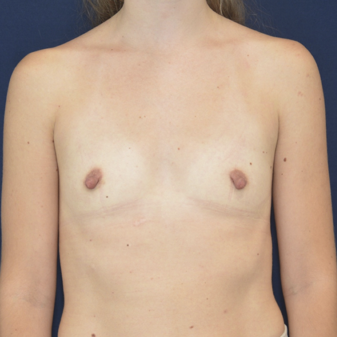 aumento-02-01 Breast Augmentation