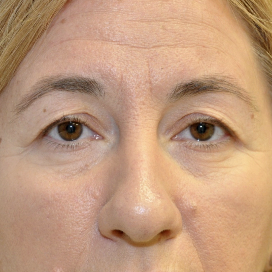 blefaroplastia-01-01 Blefaroplastia