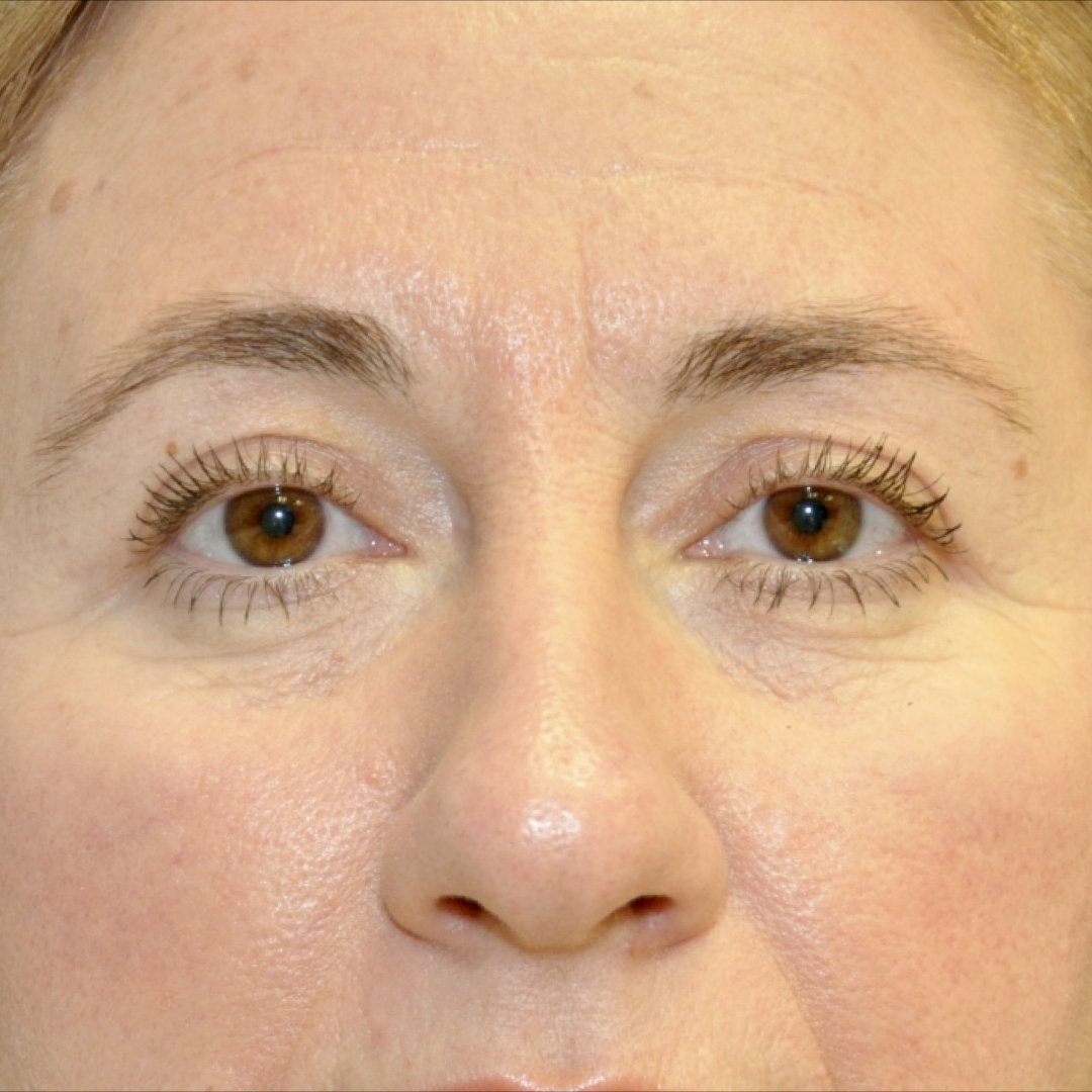 blefaroplastia-01-02 Blefaroplastia