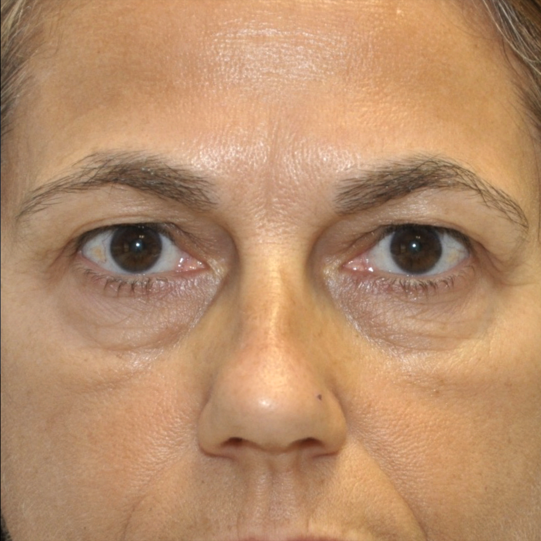 blefaroplastia-02-01 Blefaroplastia
