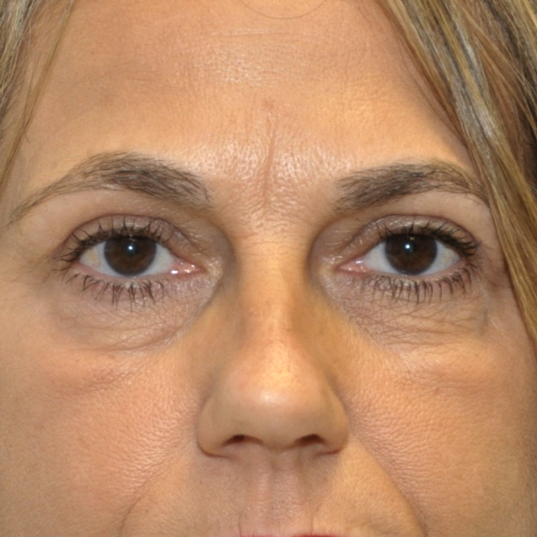 blefaroplastia-02-02 Blefaroplastia