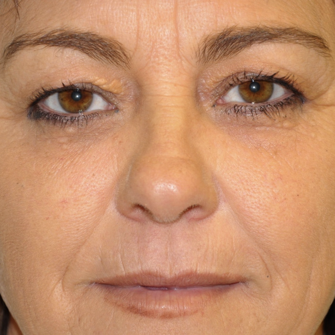 blefaroplastia-03-01 Blefaroplastia