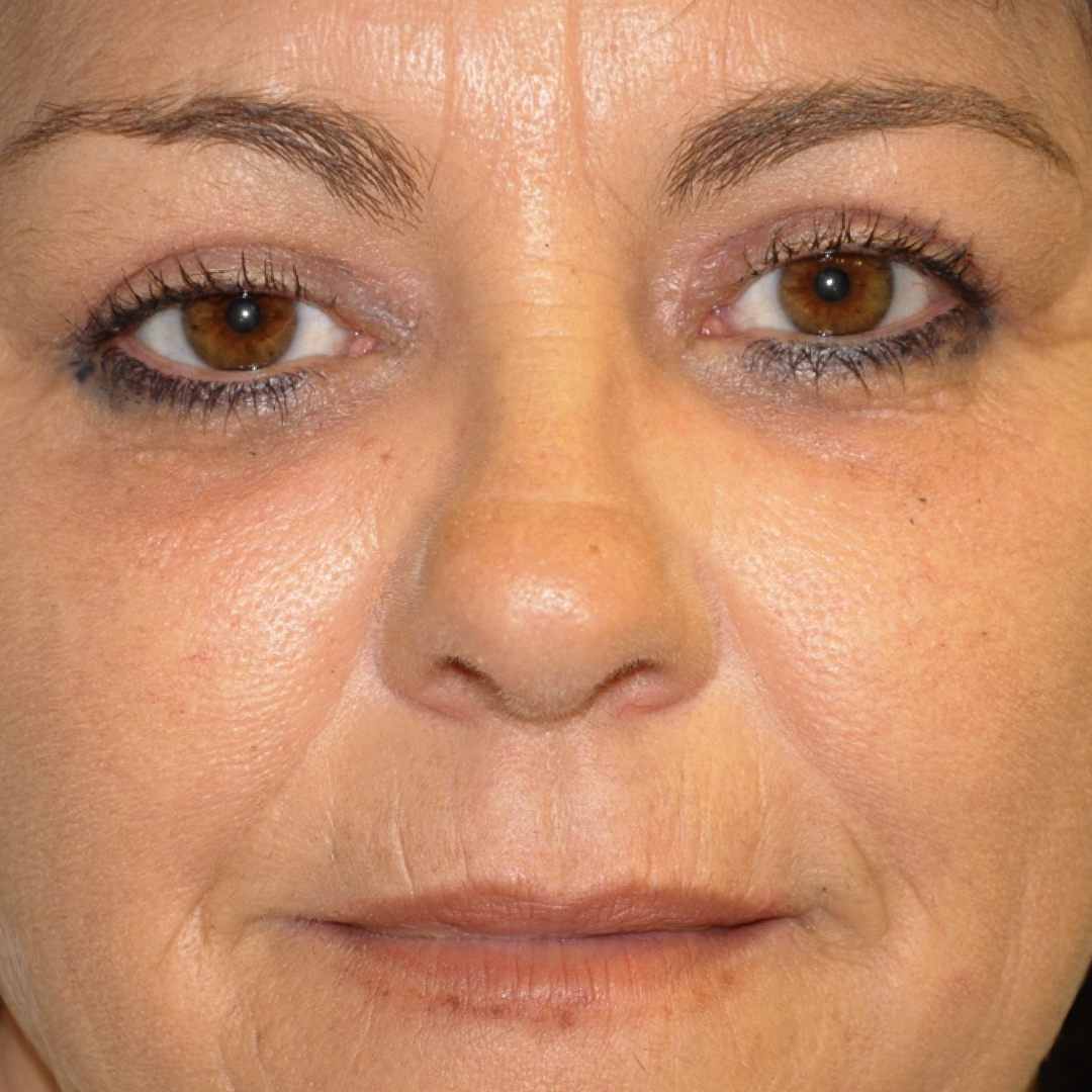 blefaroplastia-03-02 Blefaroplastia