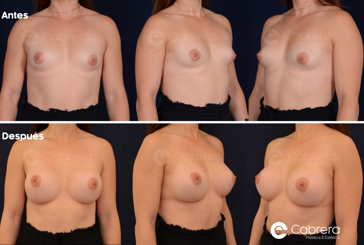 caso-105-9003-c Antes y después en mamas tuberosas