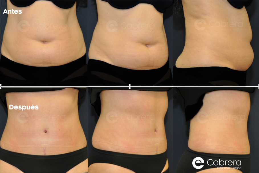 caso-26C Antes y después en abdominoplastia