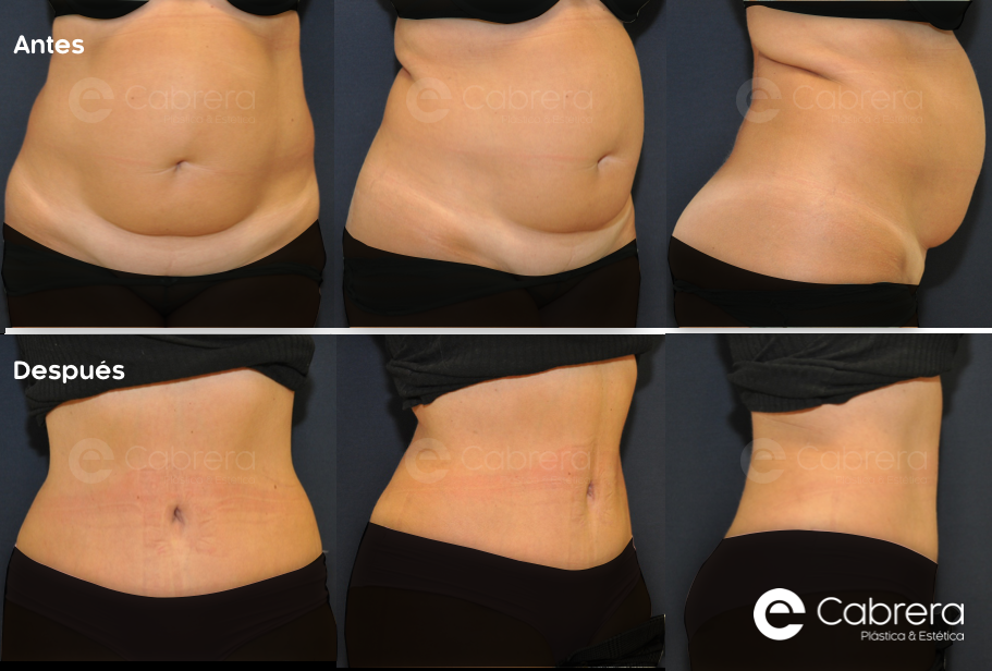 caso-30C Antes y después en abdominoplastia