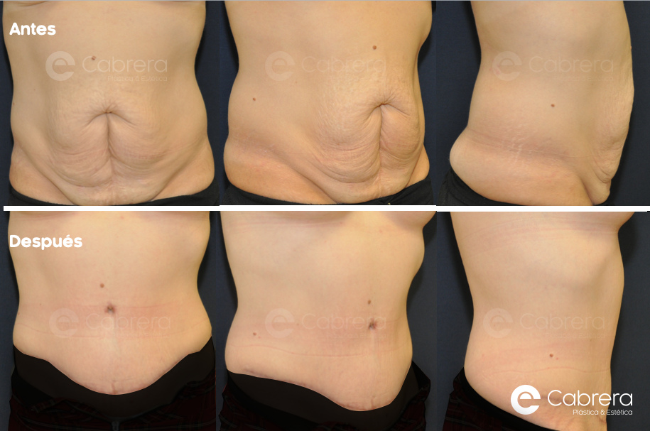 caso-31-C Antes y después en abdominoplastia