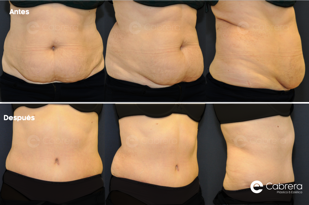 caso-35C Antes y después en abdominoplastia