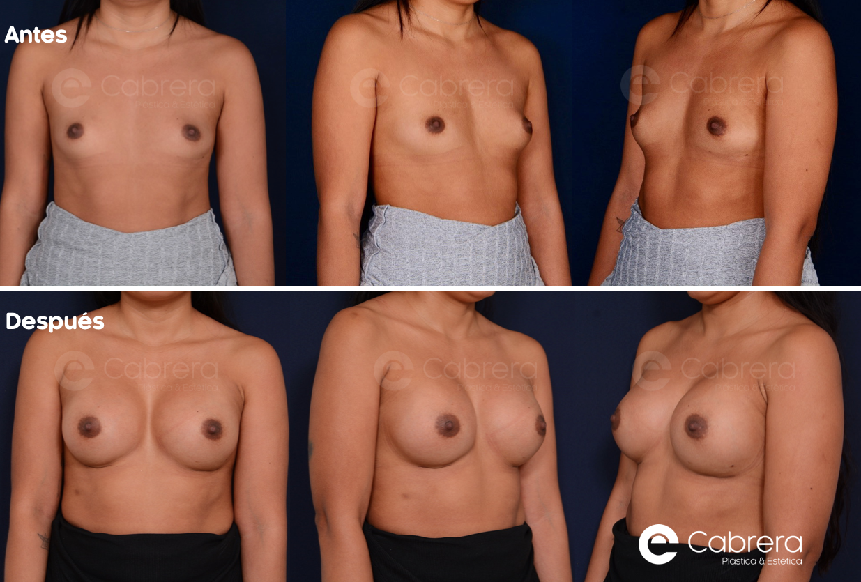 caso-98-8857-c Antes y después en mamas tuberosas