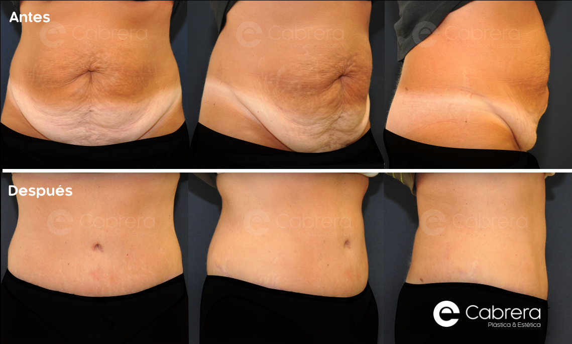 caso13C Antes y después en abdominoplastia