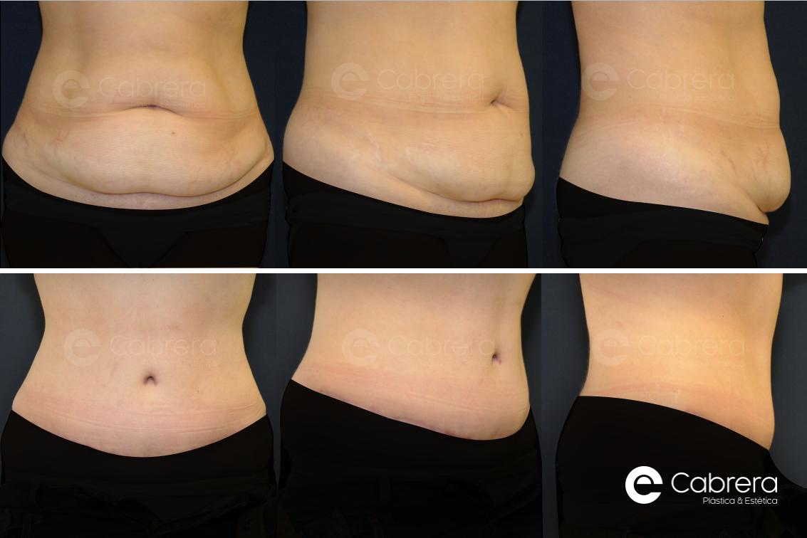 caso14-lipo Antes y después en liposucción