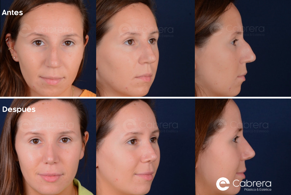caso17CC Antes y después en rinoplastia