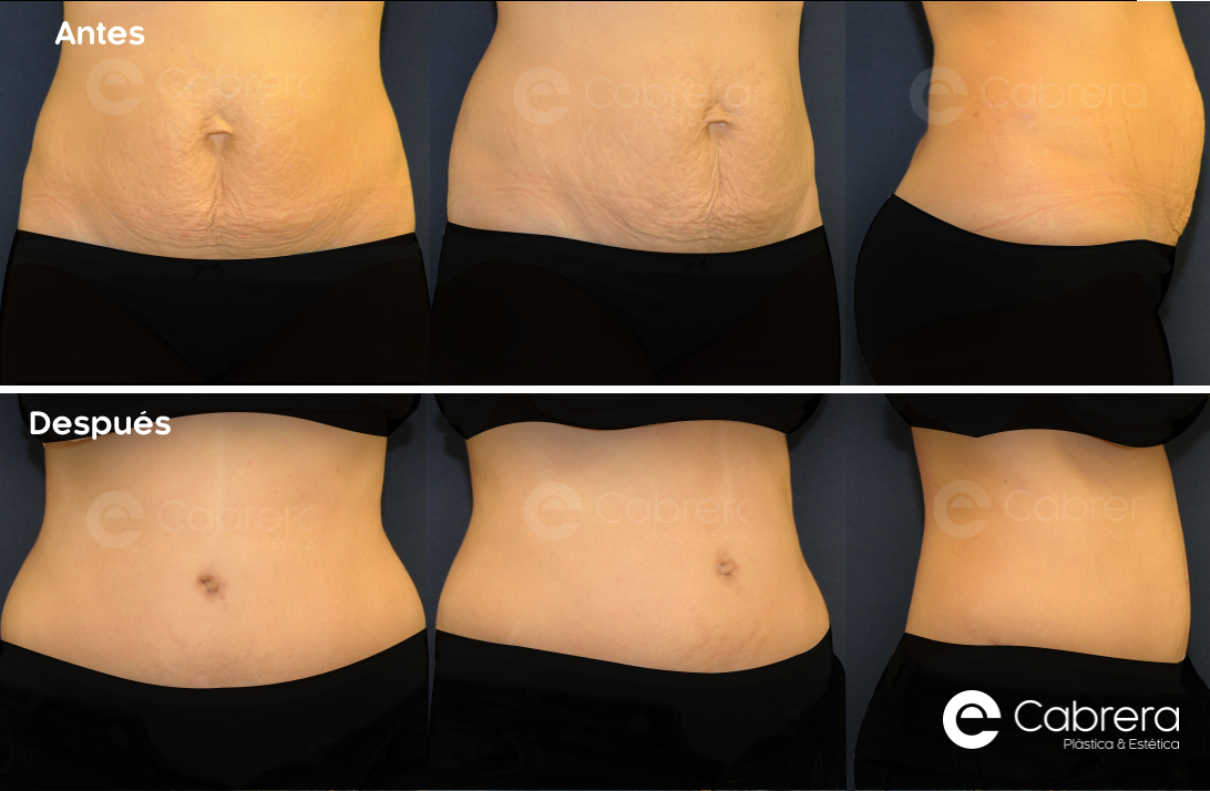 caso20C-1 Antes y después en abdominoplastia