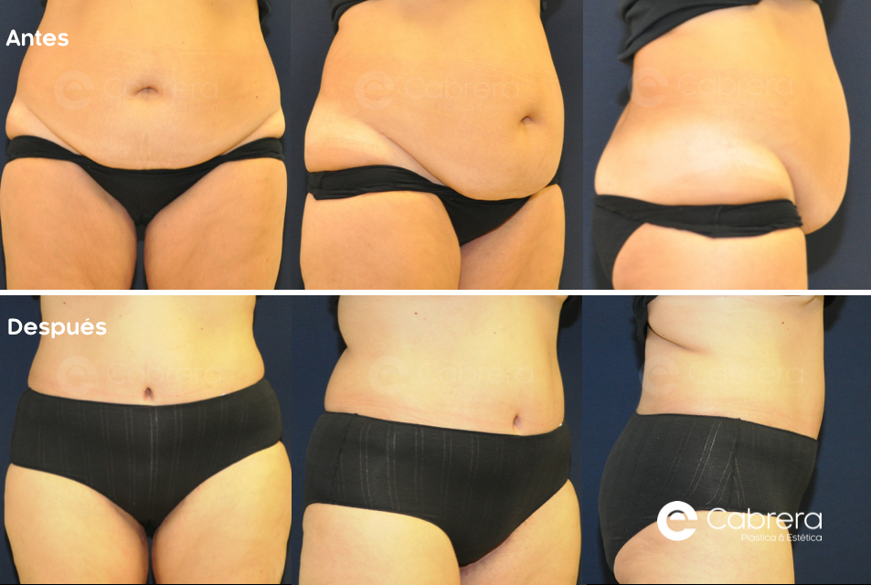 caso21C Antes y después en abdominoplastia