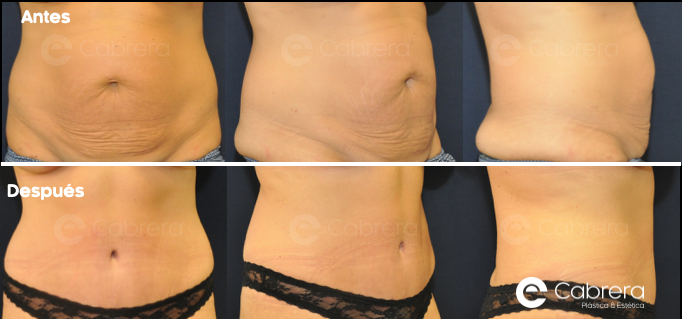 caso22C Antes y después en abdominoplastia