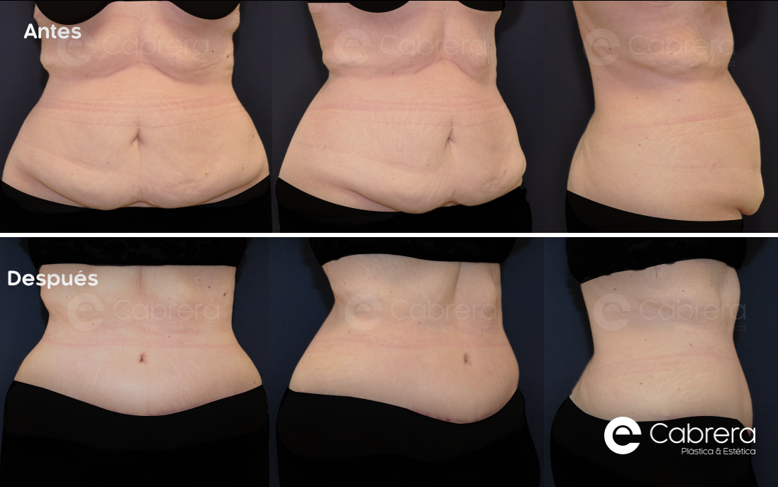 caso23C Antes y después en abdominoplastia