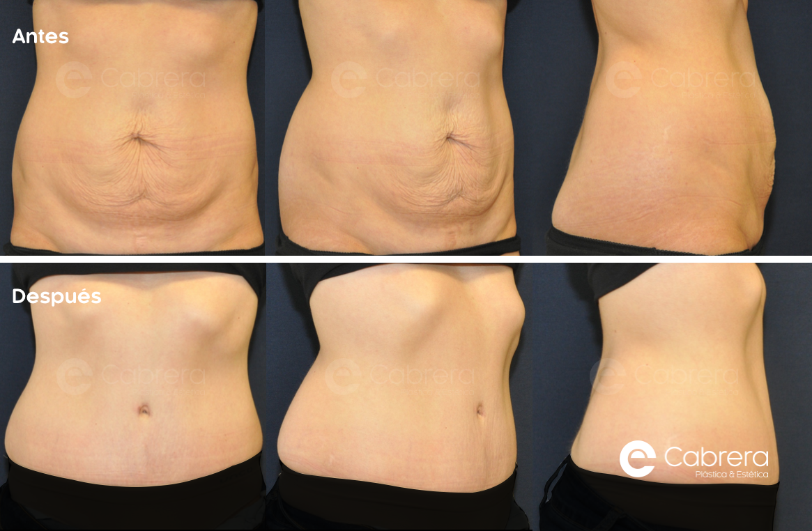 caso28C-1 Antes y después en abdominoplastia