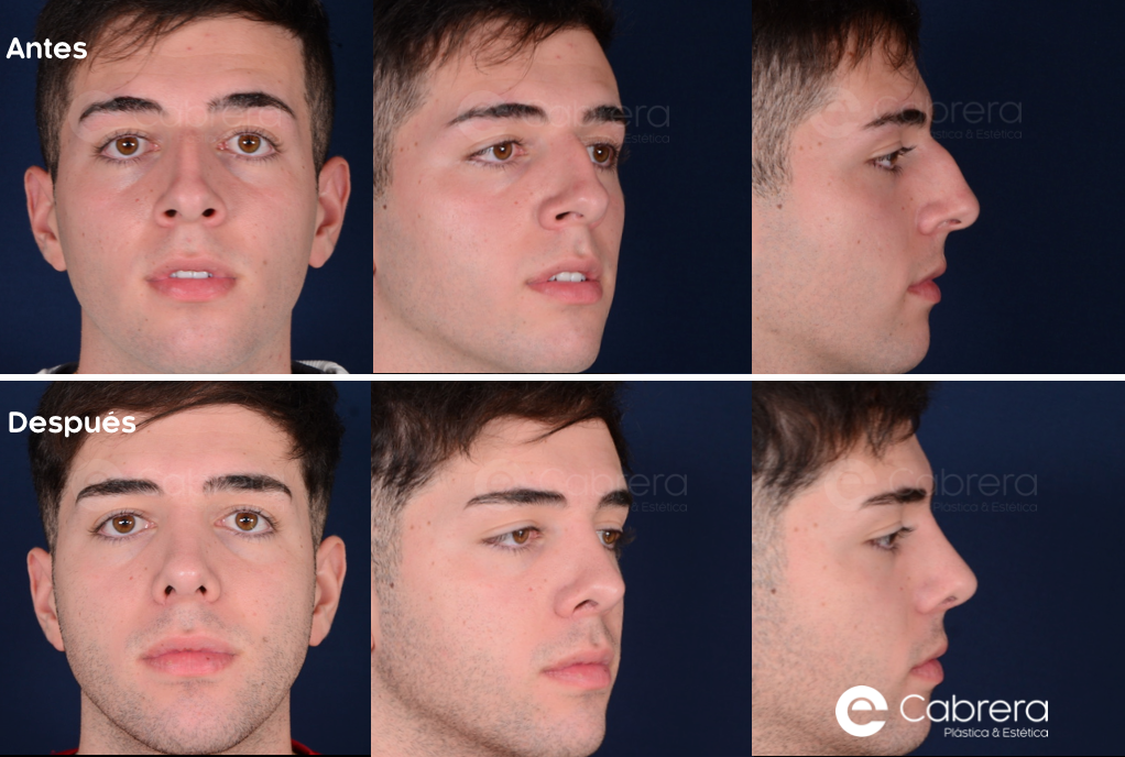 caso28C-2 Antes y después en rinoplastia
