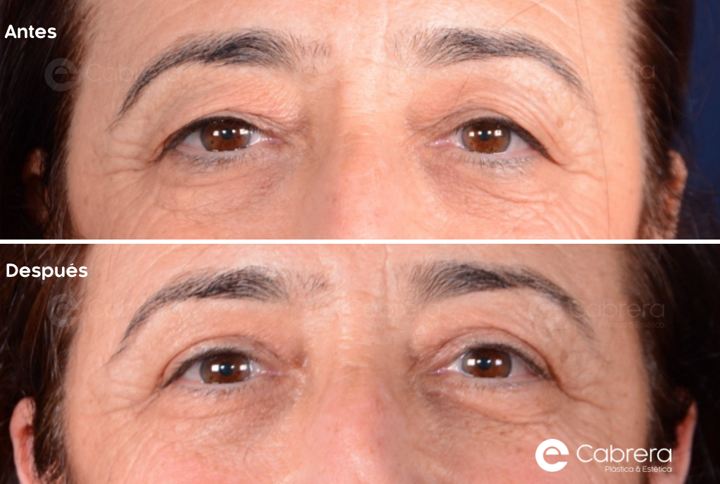 caso28C Antes y después en blefaroplastia