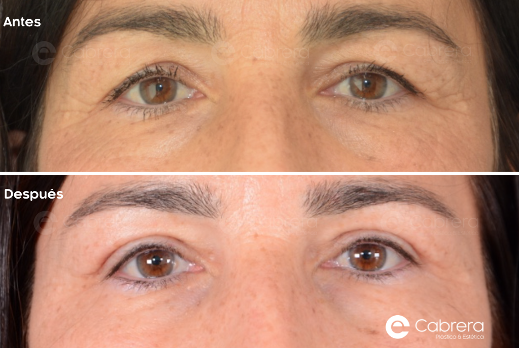 caso29C Antes y después en blefaroplastia