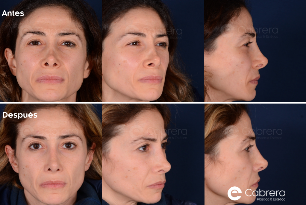 caso29CC-1 Antes y después en rinoplastia