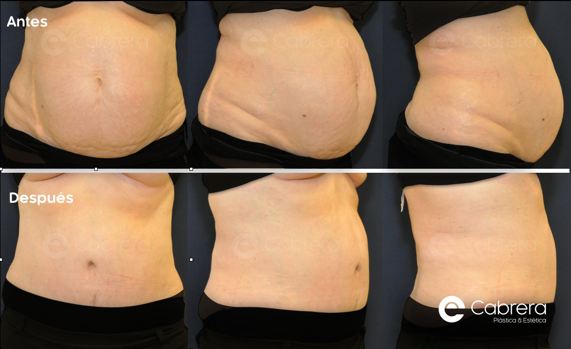 caso29CC Antes y después en abdominoplastia