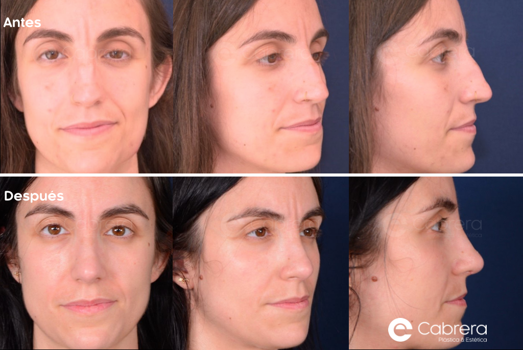 caso30C Antes y después en rinoplastia