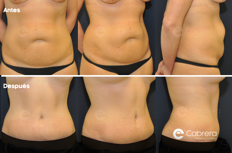 caso33-C Antes y después en abdominoplastia