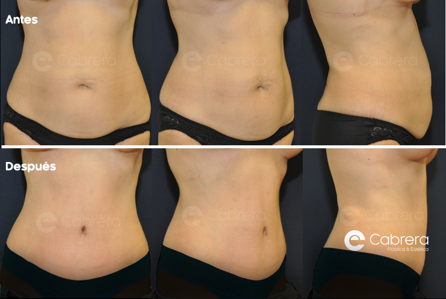 caso34C Antes y después en abdominoplastia