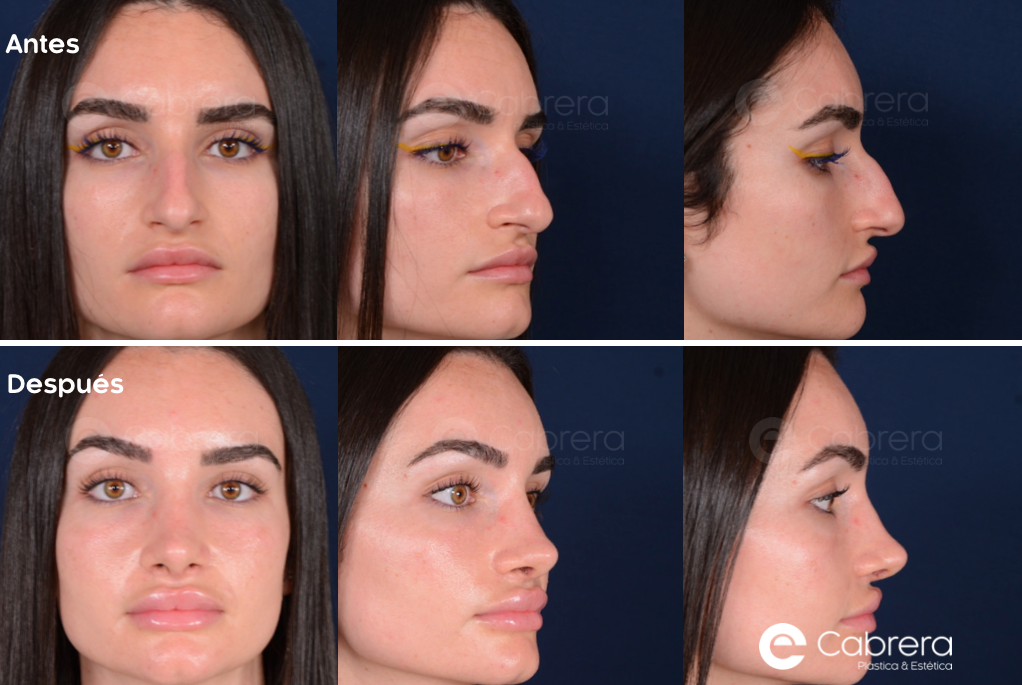 caso36C-1 Antes y después en rinoplastia