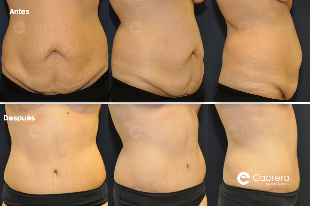 caso36C Antes y después en abdominoplastia