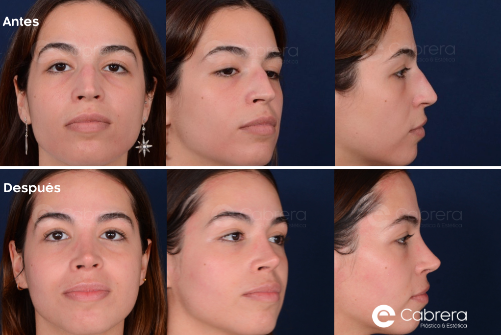 caso38C Antes y después en rinoplastia