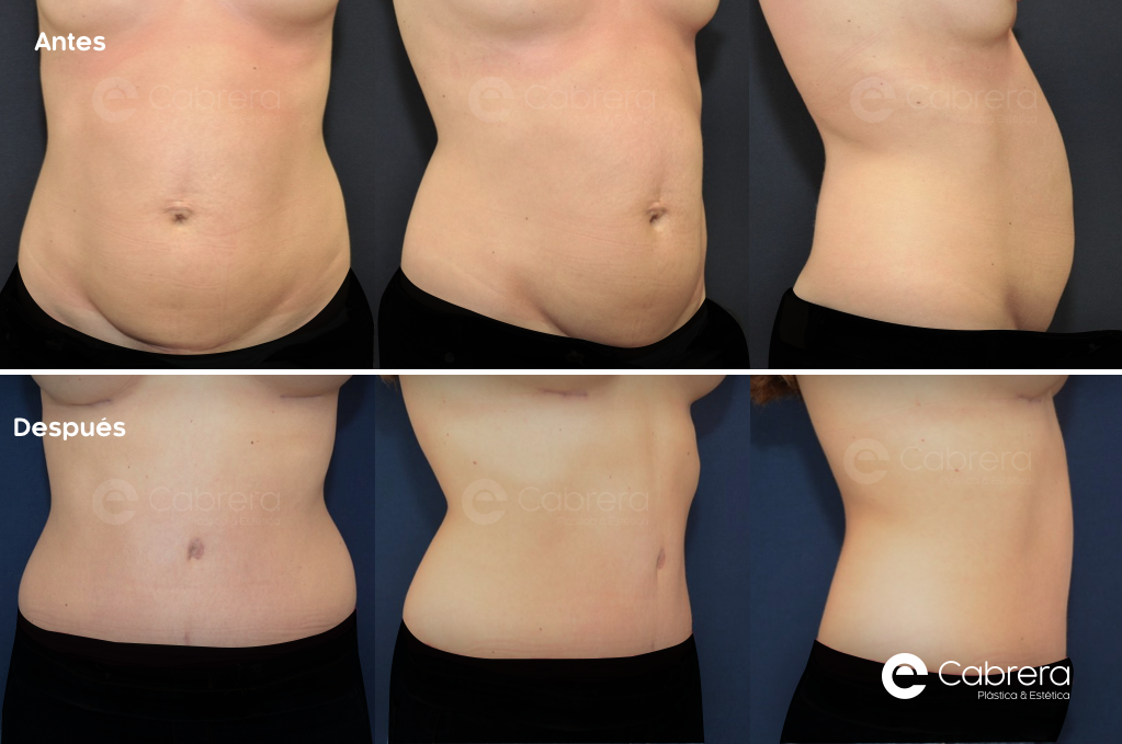 caso39C Antes y después en abdominoplastia
