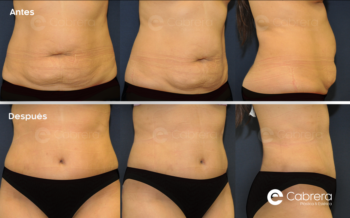 caso3C Antes y después en abdominoplastia