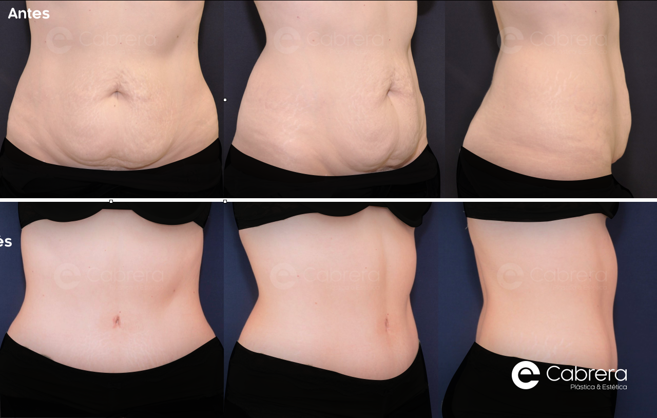 caso40C Antes y después en abdominoplastia
