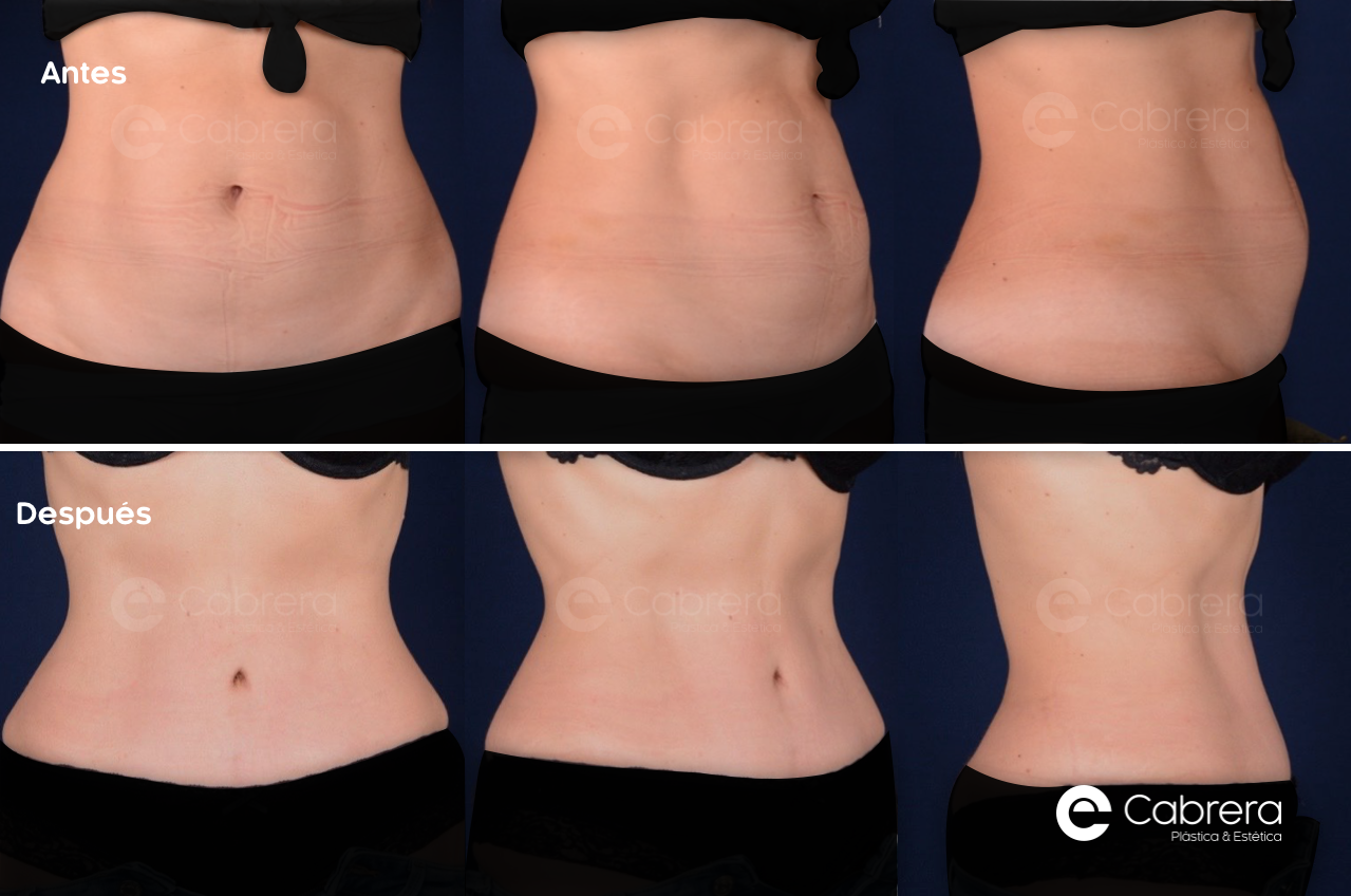 caso52C Antes y después en abdominoplastia