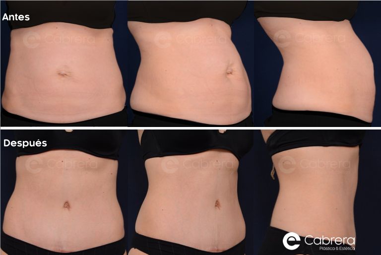 caso56C Antes y después en abdominoplastia