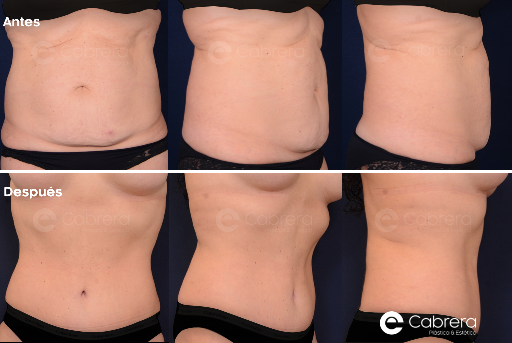 caso59C Antes y después en abdominoplastia