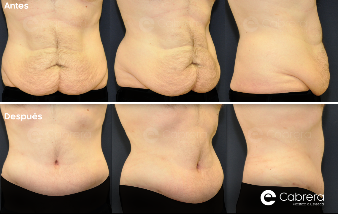 caso6C Antes y después en abdominoplastia