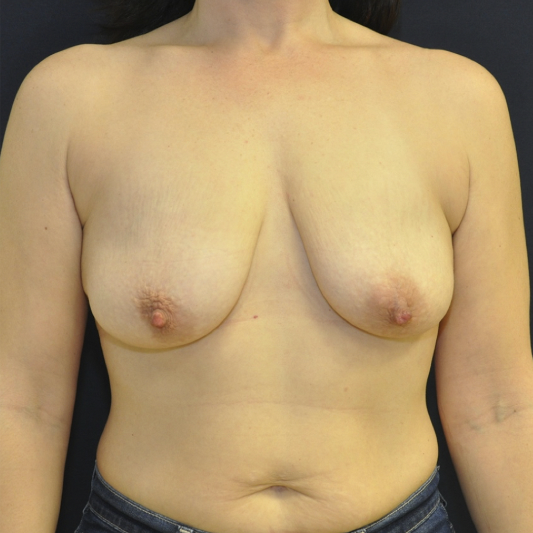 mastopexia-con-implante-01-01 Breast Lift