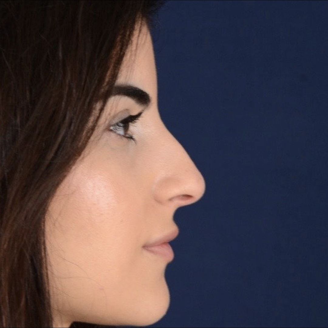 rinoplastia-01-01 Rhinoplasty