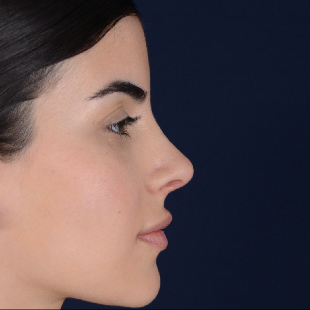rinoplastia-01-02 Rhinoplasty