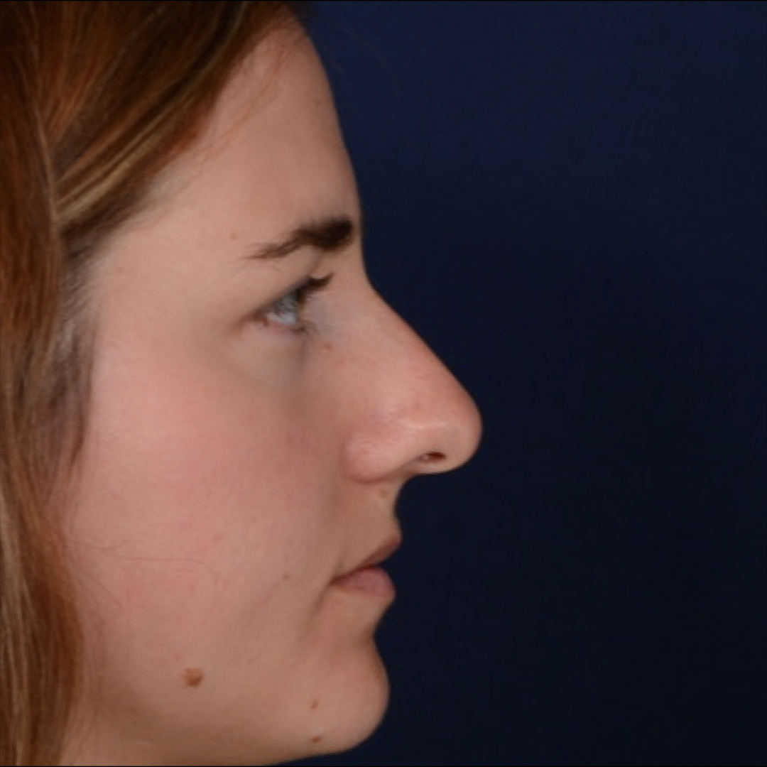 rinoplastia-02-01 Rhinoplasty