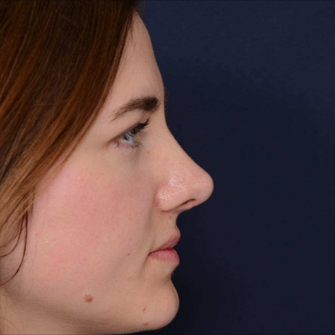 rinoplastia-02-02 Rhinoplasty